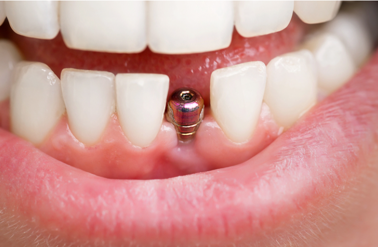 Dental Implants: What to Expect Before, During, and After the Procedure